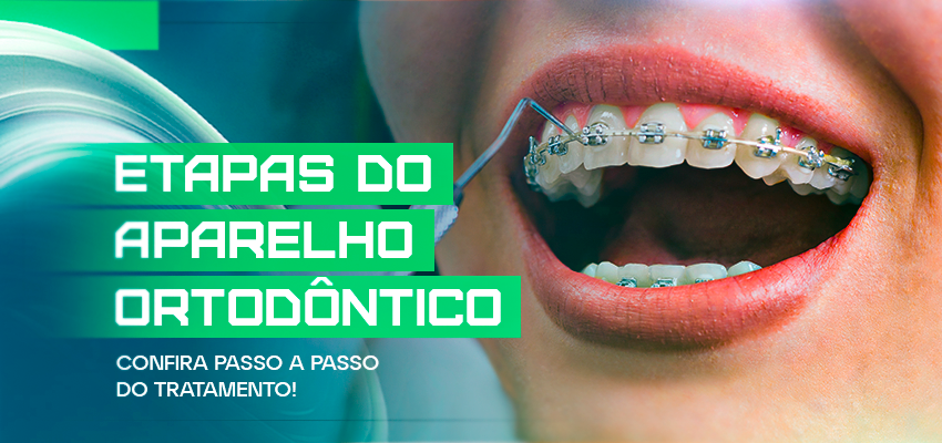 Etapas do aparelho ortodôntico