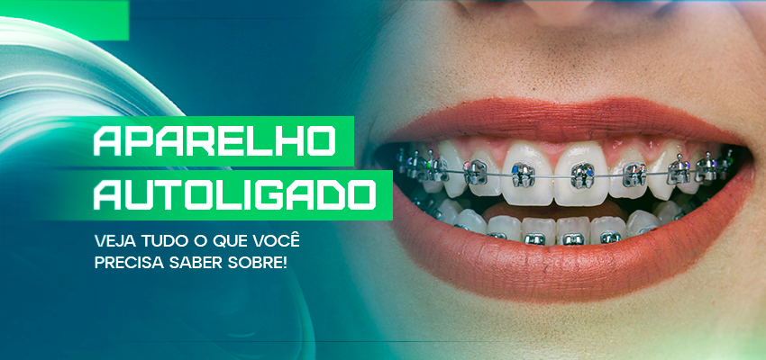 Aparelho autoligado: veja tudo o que você precisa saber sobre!