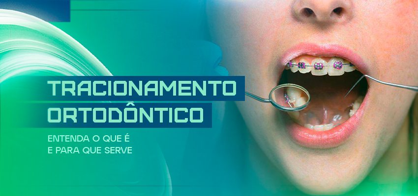 Tracionamento ortodôntico