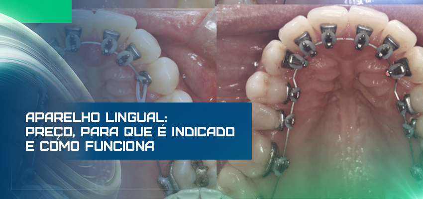 Aparelho lingual