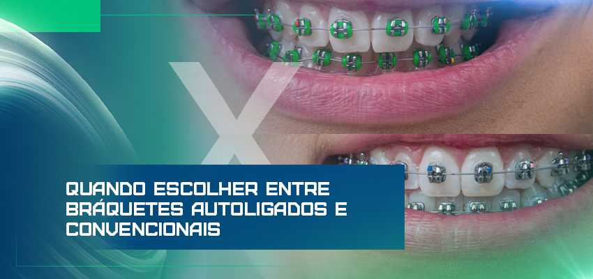 Quando escolher entre bráquetes autoligados e convencionais