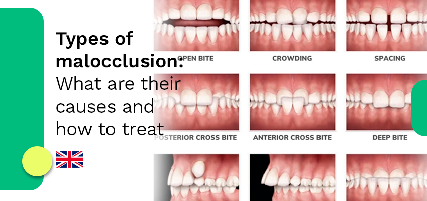 Types of occlusion
