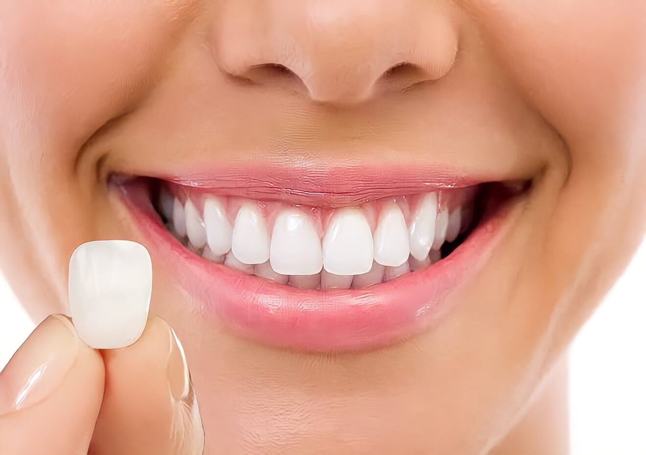 Tipos e quanto custa as lentes de contato dental