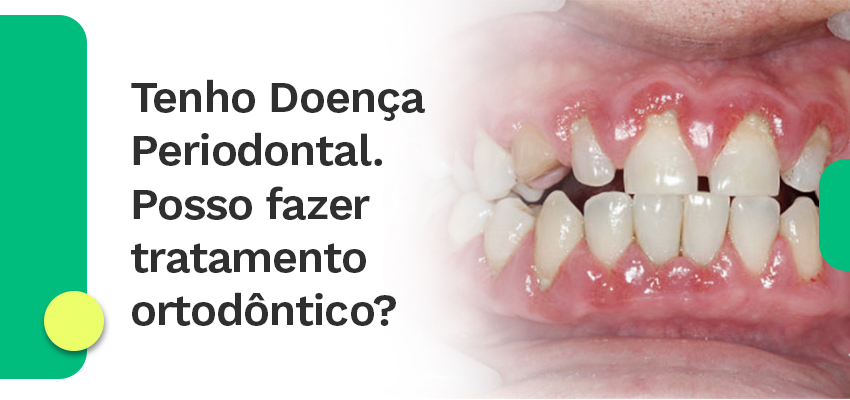 Doença Periodontal
