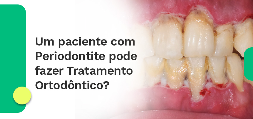 Um paciente com Periodontite pode fazer Tratamento Ortodôntico?
