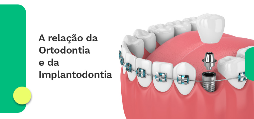 A relação da Ortodontia e da Implantodontia