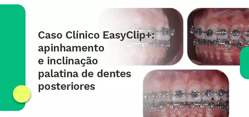 Caso Clínico EasyClip+