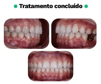 Caso Clínico de apinhamento e inclinação palatina de dentes posteriores