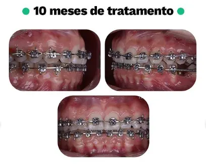 Caso Clínico de apinhamento e inclinação palatina de dentes posteriores