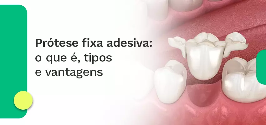 Prótese fixa adesiva
