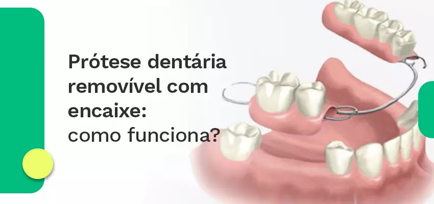 Prótese dentária removível com encaixe