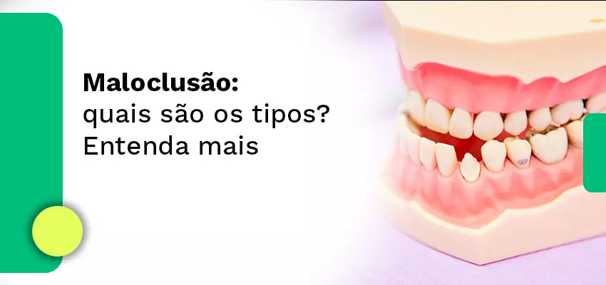 Maloclusão