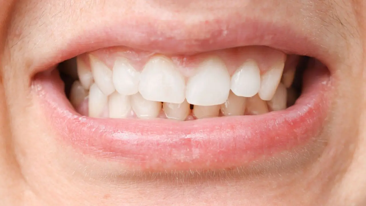 O que é a sobremordida profunda?