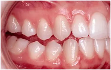 mordida aberta posterior