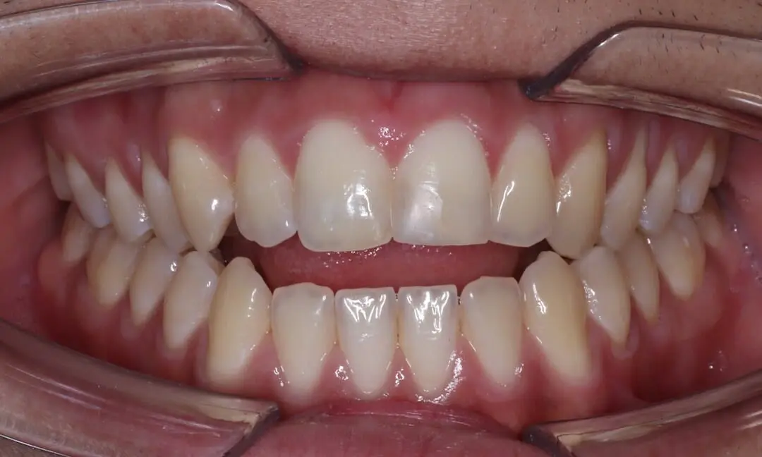 O que é mordida aberta?