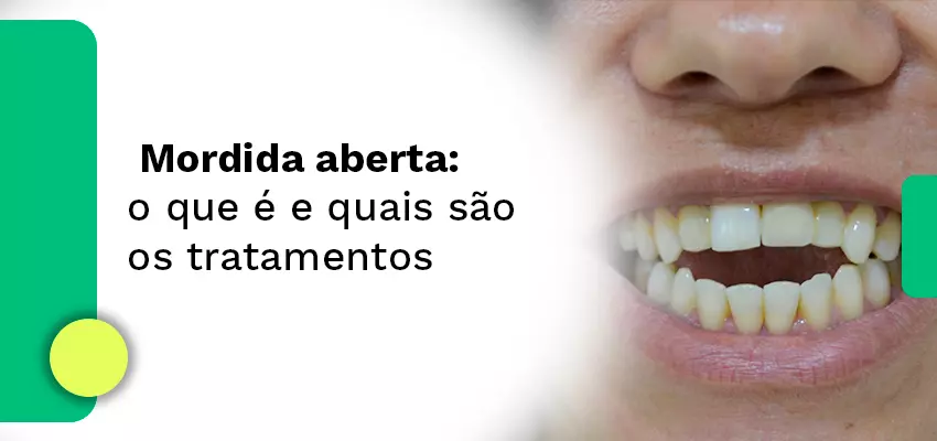 Mordida aberta