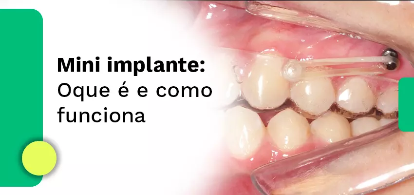 Mini implante: o que é e como funciona