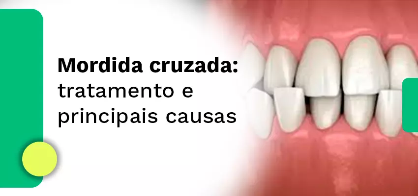 Mordida cruzada: tratamento e principais causas