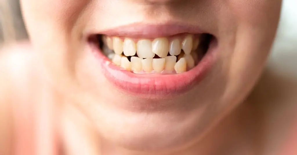 O que é mordida cruzada?