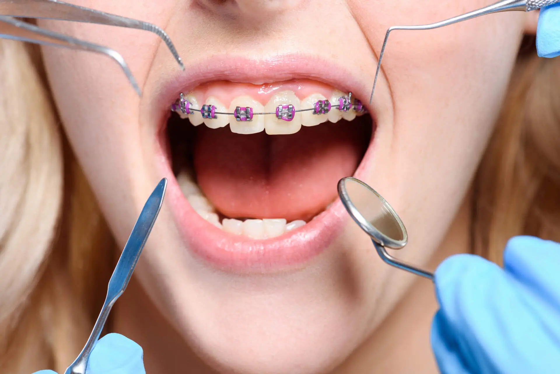 Diferenças entre aparelho ortopédico e ortodôntico