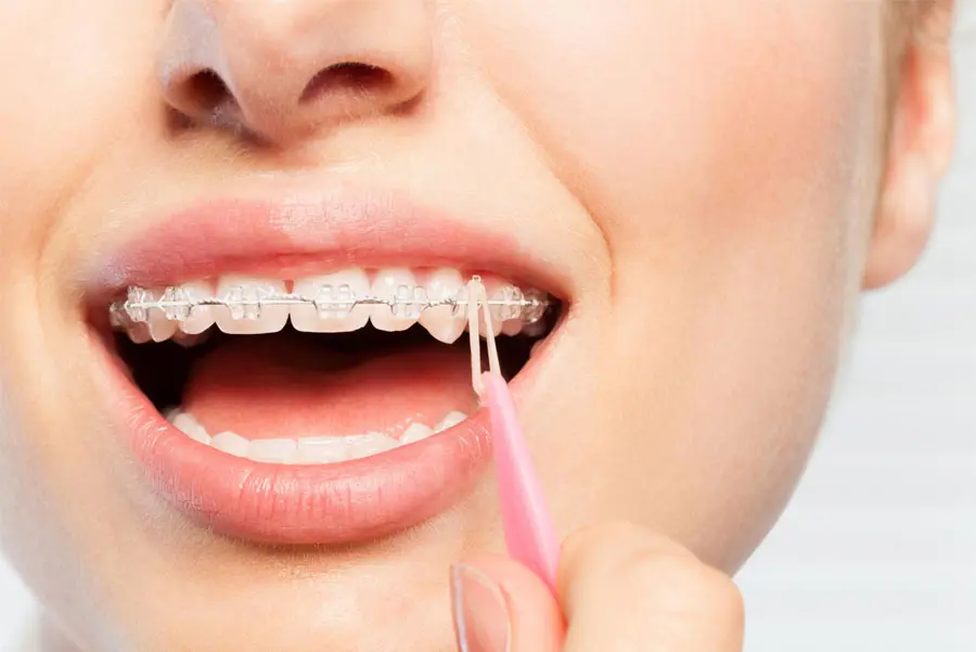 O que é o elástico intermaxilar?